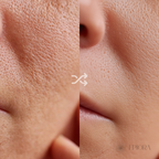 Niacinamida 20% Kit Adios Manchas